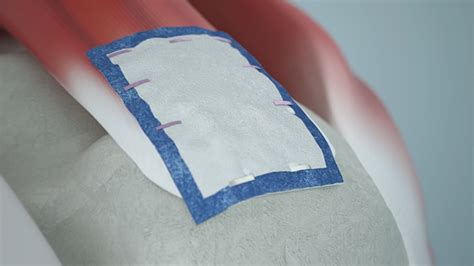 patch saddle nephew|New study confirms Smith+Nephew’s REGENETEN Bioinductive .